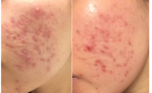 トレチノイン治療前後の肌の比較